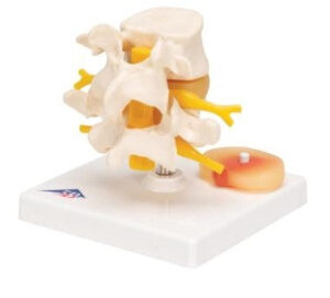 Human Lumbar Spinal Column with Prolapsed Intervertebral Disc - 3B Smart Anatomy